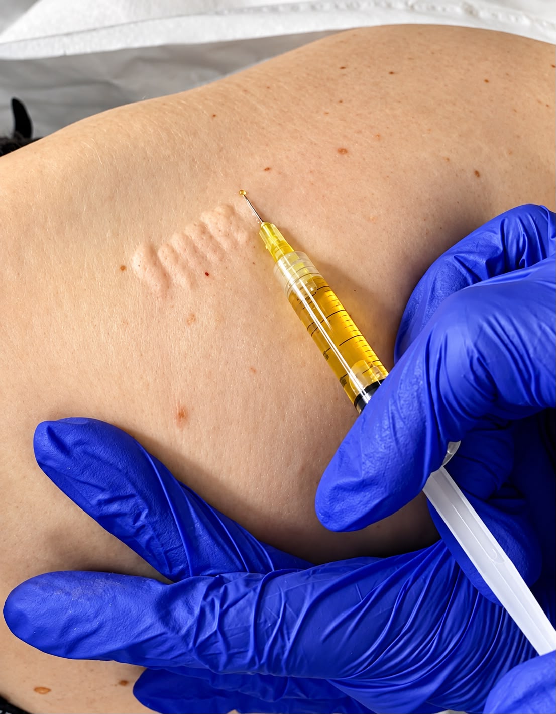 An advanced skin treatment at Bonds Aesthetics